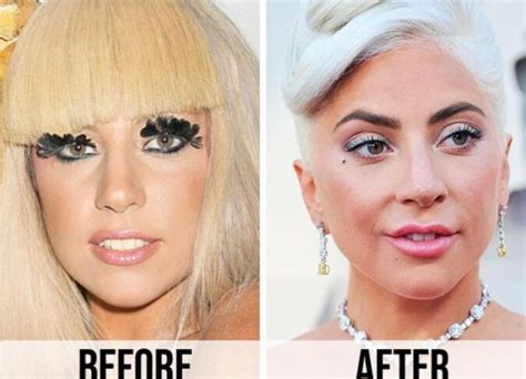 lady gaga surgery|A Surgeon Breaks Down Lady Gaga’s Potential Cosmetic